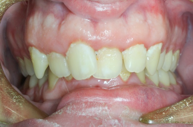 7 typov úsmevov, ktoré ľahko zachráni zubný strojček INVISALIGN. Ktorý je ten váš? 