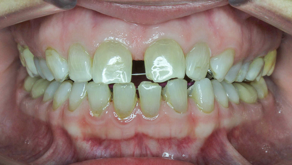 7 typov úsmevov, ktoré ľahko zachráni zubný strojček INVISALIGN. Ktorý je ten váš? 