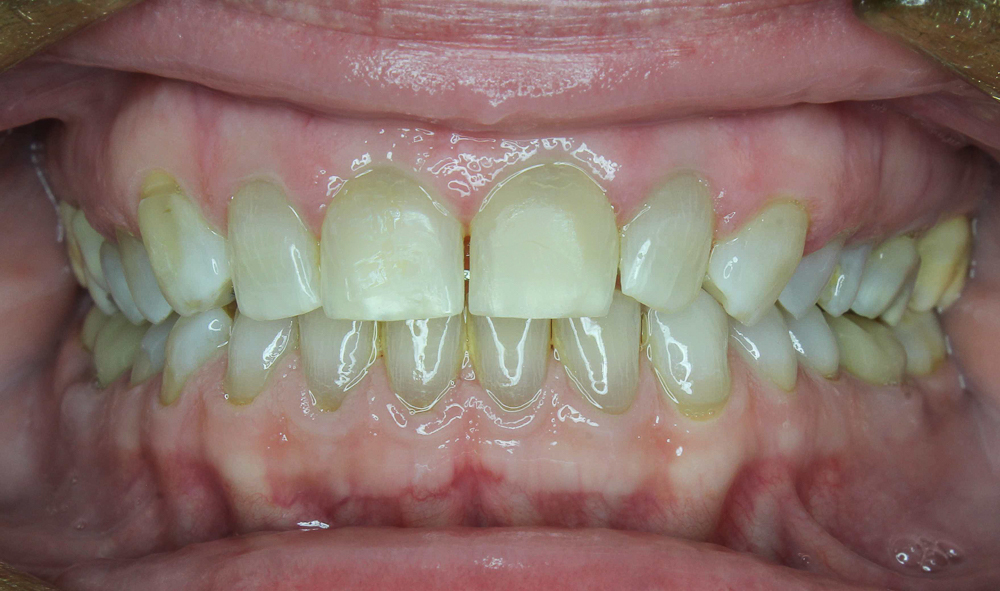 7 typov úsmevov, ktoré ľahko zachráni zubný strojček INVISALIGN. Ktorý je ten váš? 