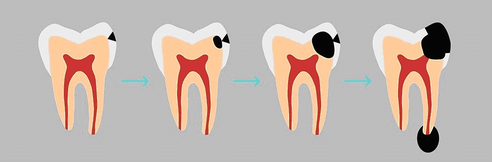 Miért szükséges a fogászati preventív kivizsgálás