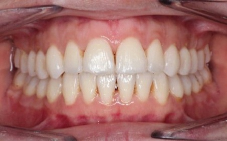 7 typov úsmevov, ktoré ľahko zachráni zubný strojček INVISALIGN. Ktorý je ten váš? 