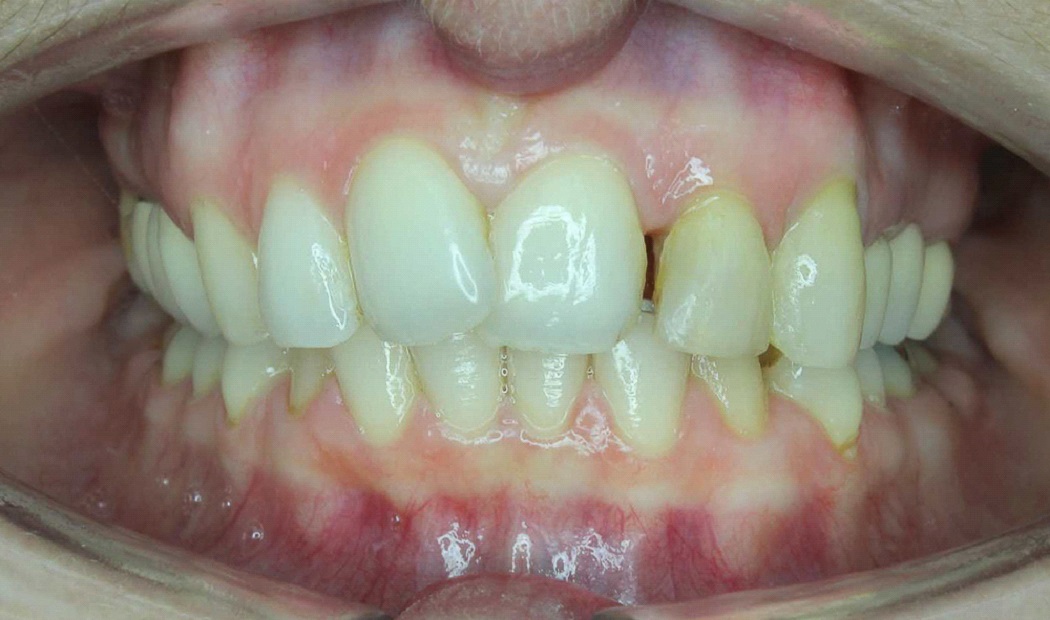 7 typov úsmevov, ktoré ľahko zachráni zubný strojček INVISALIGN. Ktorý je ten váš? 