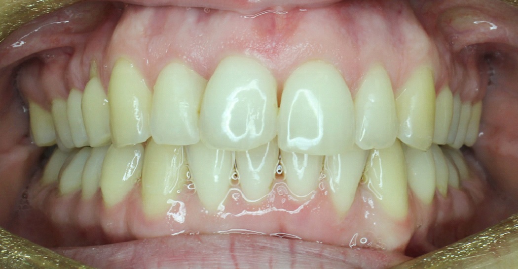 7 typov úsmevov, ktoré ľahko zachráni zubný strojček INVISALIGN. Ktorý je ten váš? 