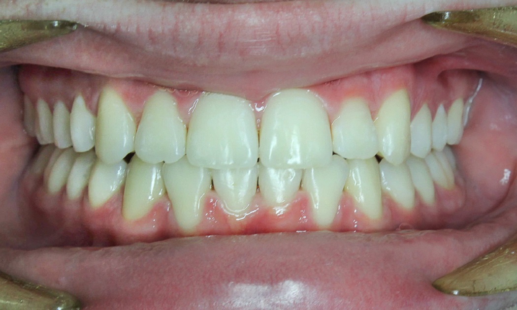 7 typov úsmevov, ktoré ľahko zachráni zubný strojček INVISALIGN. Ktorý je ten váš? 