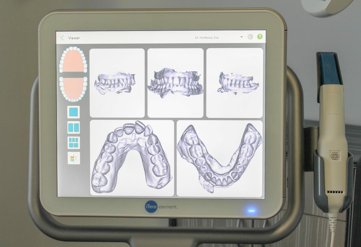 U nás už žiadne nepríjemné odtlačky, máme SCANNER iTERO od Invisalign!