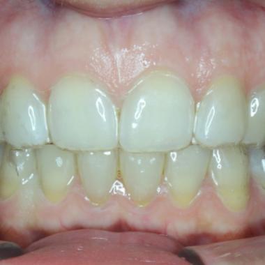 Vizualizácia - pohyb zubov aparátom INVISALIGN